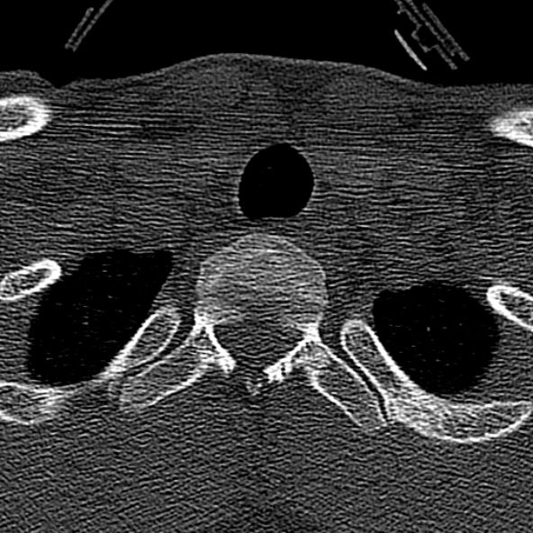 Normal CT of the cervical spine (Radiopaedia 53322-59305 Axial bone window 250).jpg