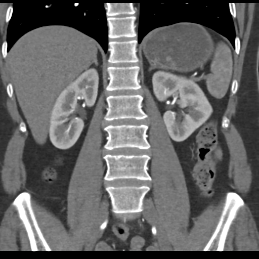 File:Normal CT renal artery angiogram (Radiopaedia 38727-40889 B 48).png