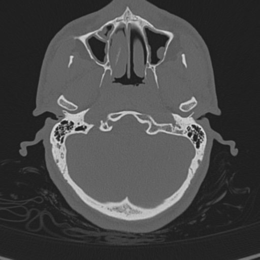 Normal CT skull (Radiopaedia 40798-43459 A 26).png