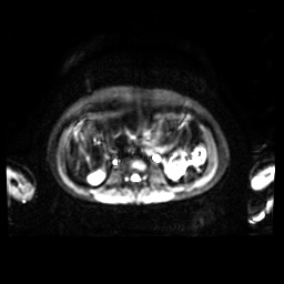 Normal MRI abdomen in pregnancy (Radiopaedia 88001-104541 Axial DWI 27).jpg