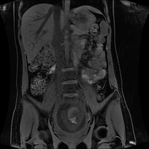 Normal MRI abdomen in pregnancy (Radiopaedia 88001-104541 M 77).jpg