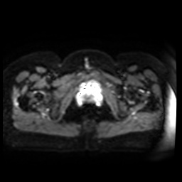 Normal MRI abdomen in pregnancy (Radiopaedia 88005-104548 Axial DWI 8).jpg