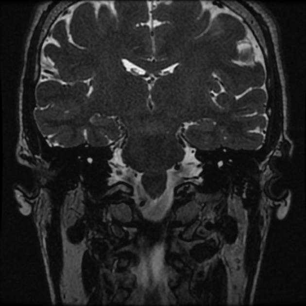 Normal MRI petrous (Radiopaedia 91317-108949 Coronal T2 53).jpg