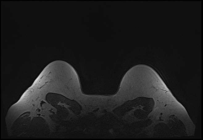 File:Normal breast MRI - dense breasts (Radiopaedia 80454-93850 Axial T1 207).jpg