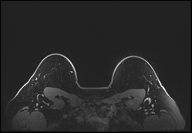 Normal breast MRI - dense breasts (Radiopaedia 80454-93850 C 202).jpg