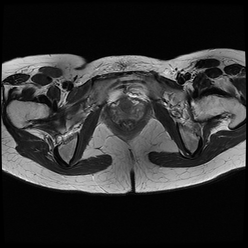File:Normal female pelvis MRI (retroverted uterus) (Radiopaedia 61832-69933 Axial T2 25).jpg