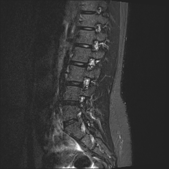 File:Normal lumbar spine MRI- 3 T (Radiopaedia 53280-59250 Sagittal STIR 9).jpg