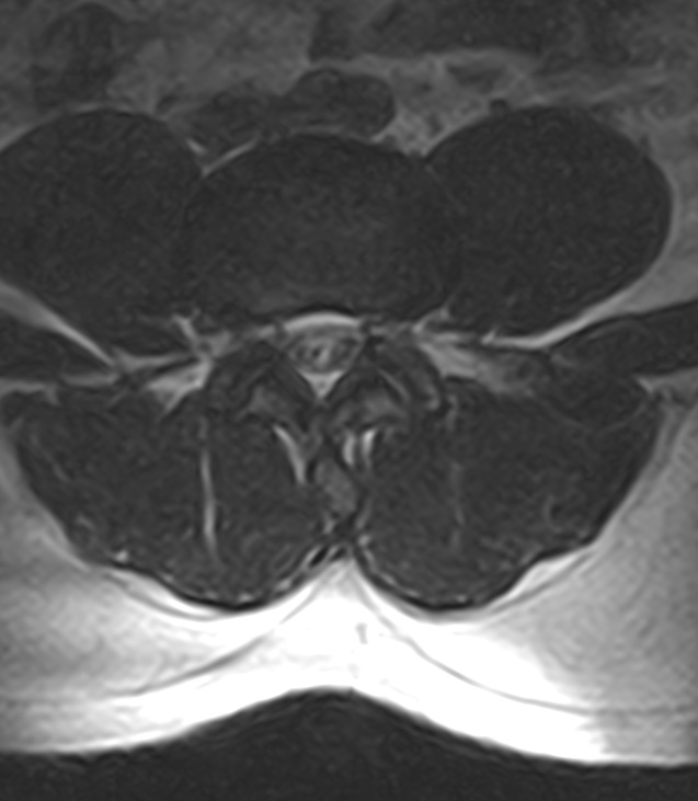 Normal lumbar spine MRI - low-field MRI scanner (Radiopaedia 40976-43699 Axial T2 64).jpg