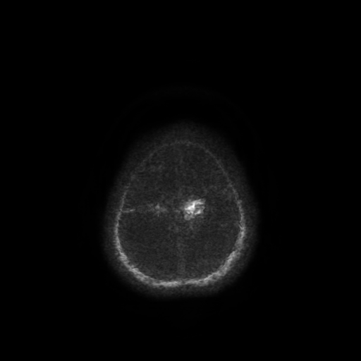 Normal noncontrast MR venography (Radiopaedia 87578-103957 Axial SWI 6).jpg