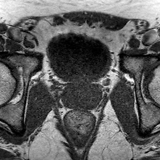 File:Normal prostate (MRI) (Radiopaedia 29986-30535 Axial T1 12).jpg