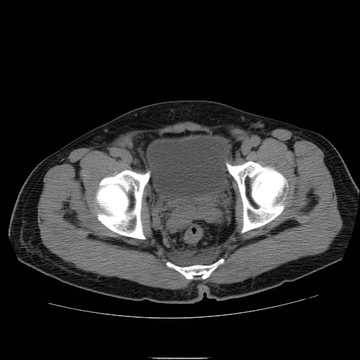 File:Obstructed kidney with perinephric urinoma (Radiopaedia 26889-27066 Axial non-contrast 62).jpg