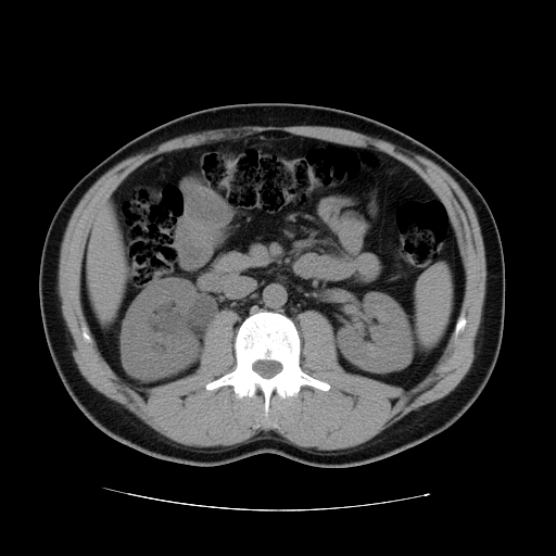 File:Obstructing ureteric calculus (Radiopaedia 18615-18514 Axial non-contrast 24).jpg