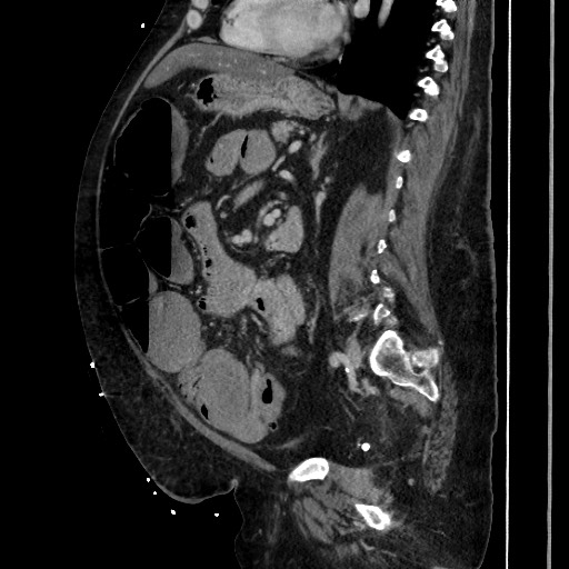 Obstructive colonic diverticular stricture (Radiopaedia 81085-94675 C 141).jpg