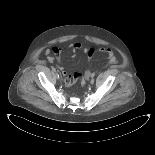 File:Obstructive pyelonephritis (Radiopaedia 46411-50844 Axial non-contrast 64).png