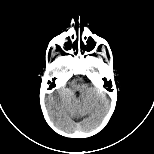 Occipital encephalocele (Radiopaedia 87339-103636 Axial non-contrast 27).jpg