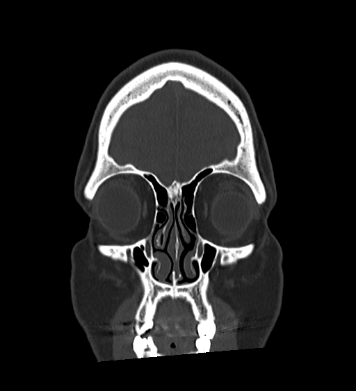 Occipital spur and Currarino type A atlas anomaly (Radiopaedia 87027-103285 Coronal bone window 36).jpg