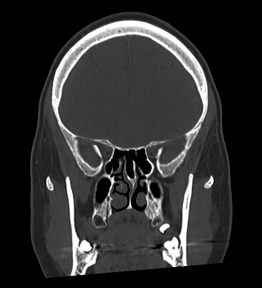 Occipital spur and Currarino type A atlas anomaly (Radiopaedia 87027-103285 Coronal bone window 59).jpg
