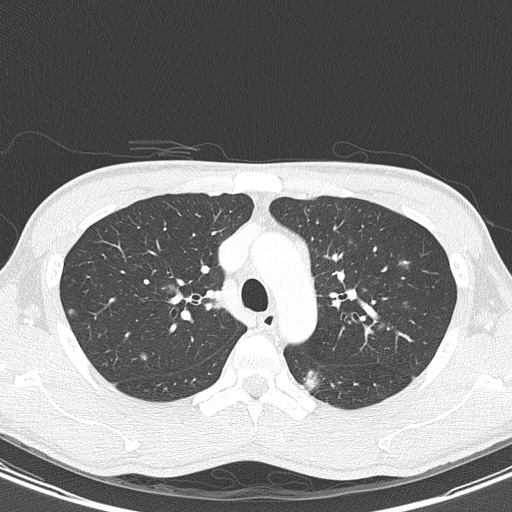 AIDS-related Kaposi sarcoma (Radiopaedia 85247-100811 Axial lung window 49).jpg