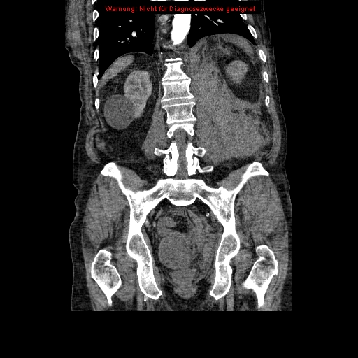 File:Abdominal aortic aneurysm- extremely large, ruptured (Radiopaedia 19882-19921 Coronal C+ arterial phase 73).jpg