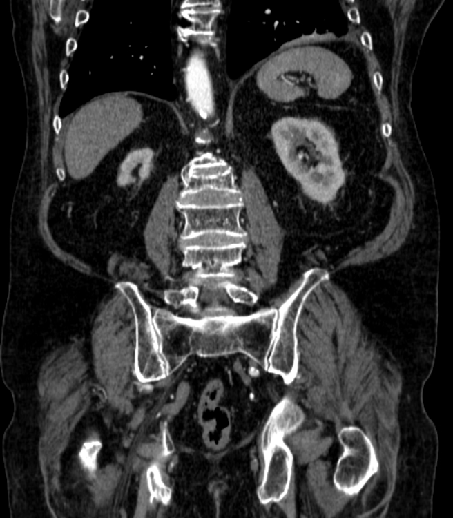 Abdominal aortic aneurysm (Radiopaedia 25855-26001 Coronal C+ arterial phase 55).jpg