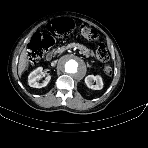 Abdominal aortic aneurysm (Radiopaedia 67117-76452 Axial C+ arterial phase 49).jpg