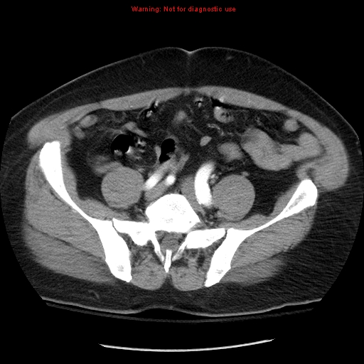 File:Abdominal aortic aneurysm (Radiopaedia 8190-9038 Axial C+ arterial phase 59).jpg