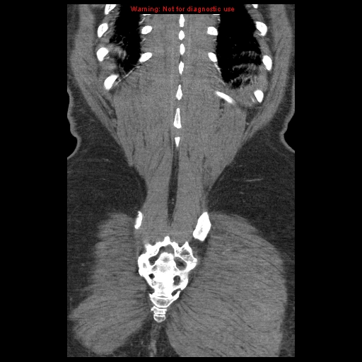 Abdominal aortic aneurysm (Radiopaedia 8190-9038 Coronal C+ arterial phase 117).jpg