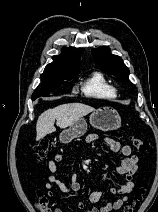 Abdominal aortic aneurysm (Radiopaedia 83094-97462 Coronal renal cortical phase 27).jpg