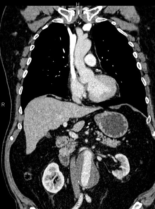 Abdominal aortic aneurysm (Radiopaedia 83094-97462 Coronal renal cortical phase 44).jpg