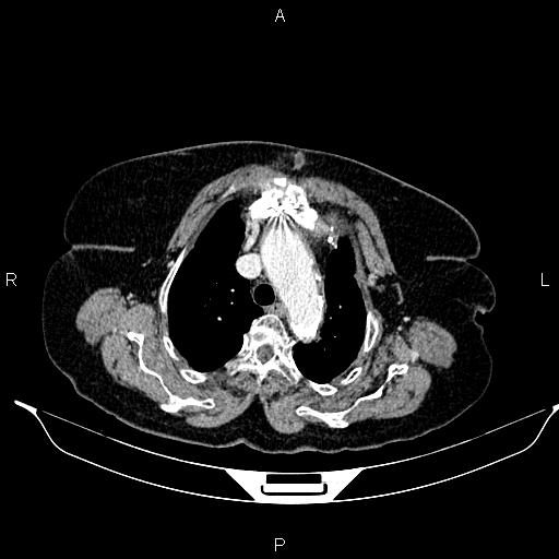 File:Abdominal aortic aneurysm (Radiopaedia 85063-100606 Axial C+ portal venous phase 11).jpg