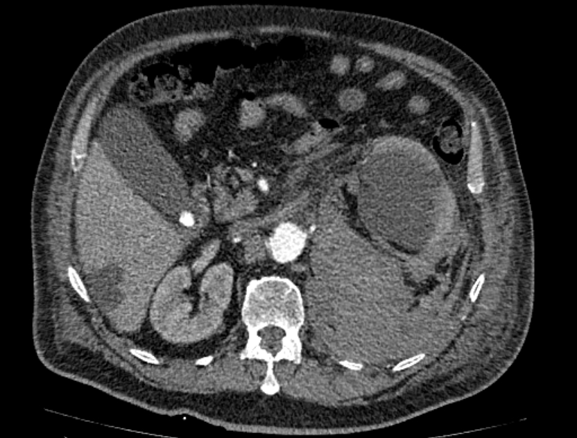 Abdominal aortic aneurysm rupture (Radiopaedia 54179-60362 Axial C+ arterial phase 28).jpg
