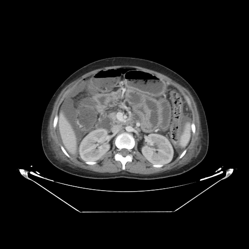 Abdominal gossypiboma- surgical towel (Radiopaedia 57288-64226 Axial C+ portal venous phase 23).jpg