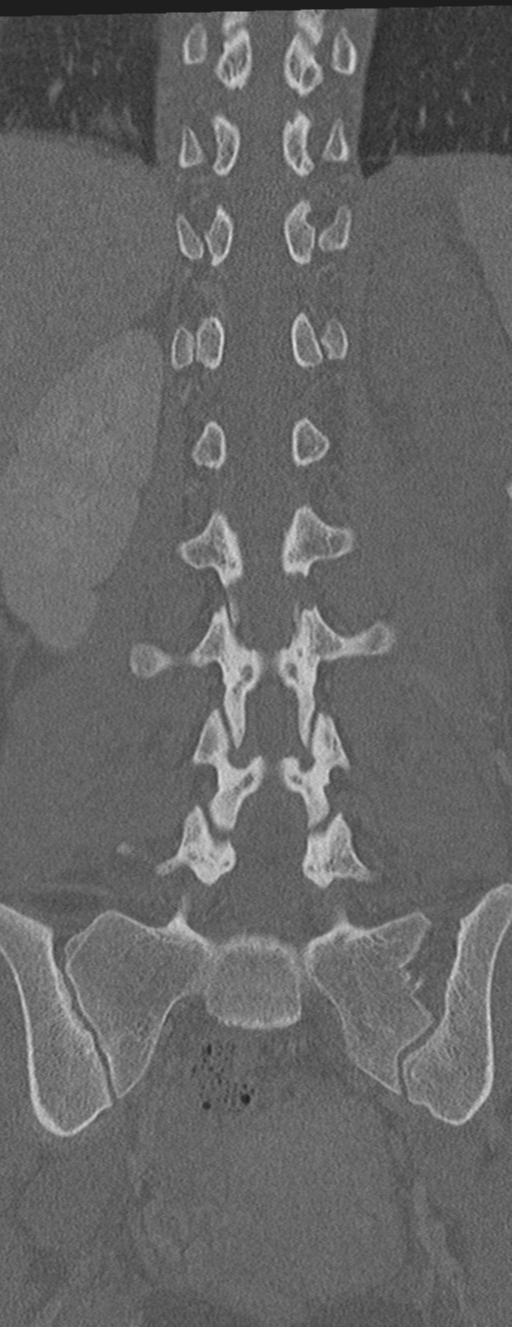 Abdominal multi-trauma - devascularised kidney and liver, spleen and pancreatic lacerations (Radiopaedia 34984-36486 Coronal bone window 44).png