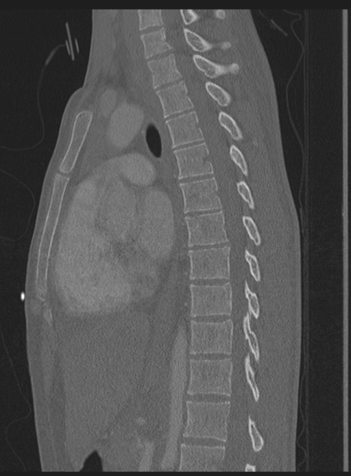 Abdominal multi-trauma - devascularised kidney and liver, spleen and pancreatic lacerations (Radiopaedia 34984-36486 Sagittal bone window 31).png