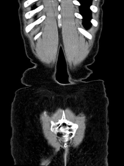 Abdominal wall and retroperitoneal tuberculosis (Radiopaedia 88137-104729 Coronal C+ portal venous phase 96).jpg