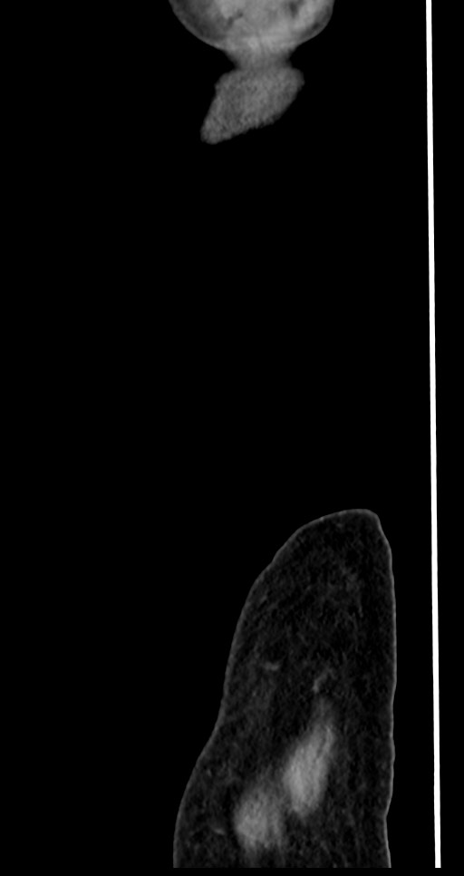 Abdominal wall and retroperitoneal tuberculosis (Radiopaedia 88137-104729 Sagittal C+ portal venous phase 147).jpg