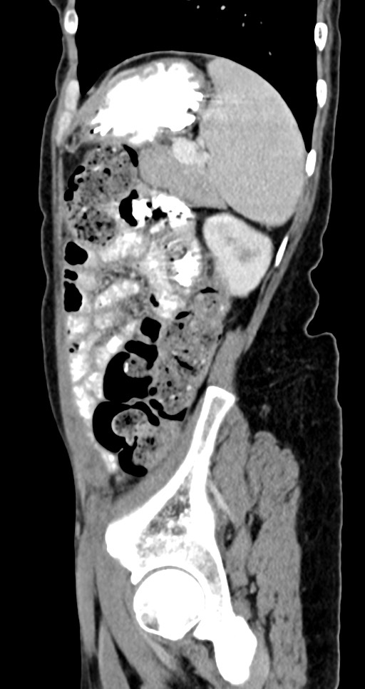 Abdominal wall and retroperitoneal tuberculosis (Radiopaedia 88137-104729 Sagittal C+ portal venous phase 38).jpg