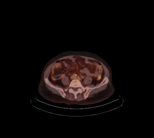 Abdominal wall metastasis from colorectal carcinoma (Radiopaedia 31016-31719 C 48).jpg