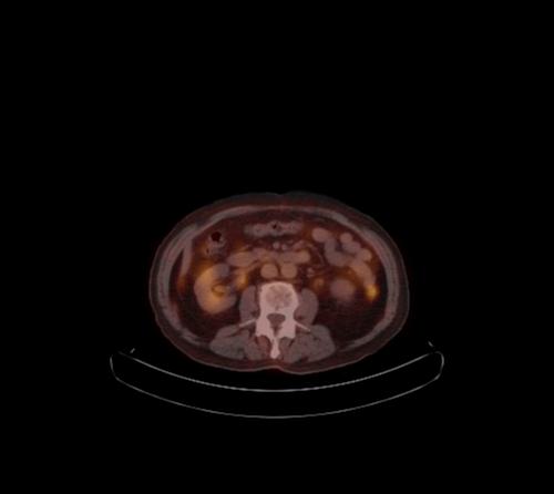 Abdominal wall metastasis from colorectal carcinoma (Radiopaedia 31016-31719 C 64).jpg
