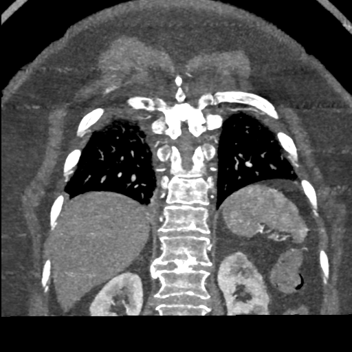 File:Aberrant right subclavian artery with Kommerell diverticulum (Radiopaedia 47982-52769 Coronal C+ arterial phase 65).png