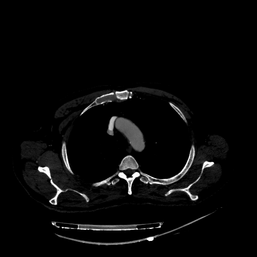 Accesory rib joint (Radiopaedia 71987-82452 Axial bone window 69).jpg