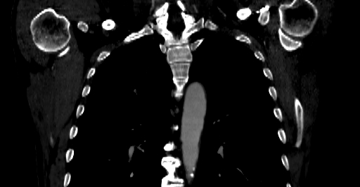 Accesory rib joint (Radiopaedia 71987-82452 Coronal bone window 19).jpg