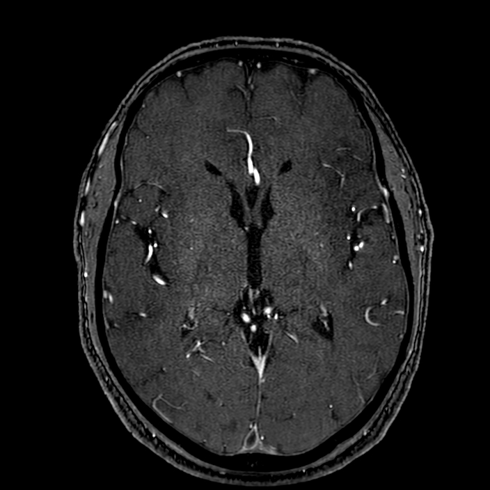 Accessory middle cerebral artery (Radiopaedia 73114-83828 Axial MRA 103).jpg