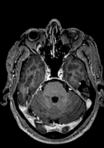 File:Accessory middle cerebral artery (Radiopaedia 73114-83828 Axial T1 C+ 109).jpg