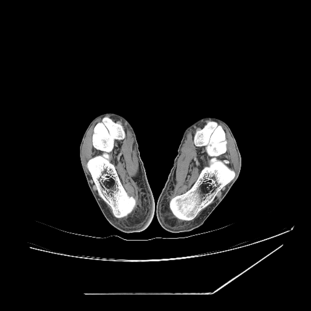 Accessory soleus muscle (Radiopaedia 61069-68943 Axial non-contrast 68).jpg