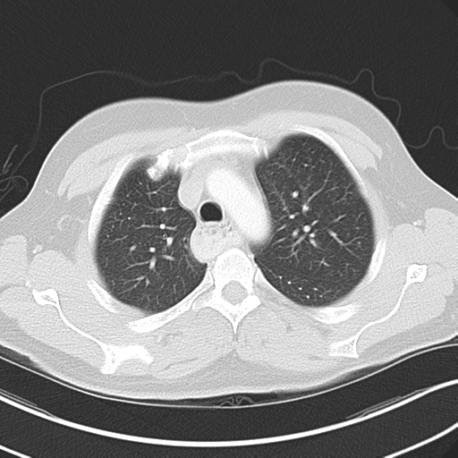 Achalasia of the cardia (Radiopaedia 38497-40595 Axial lung window 15).png