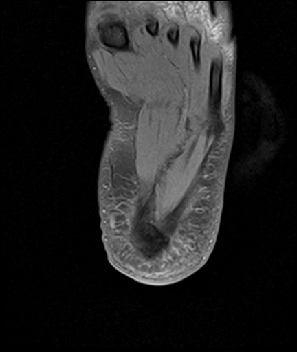 File:Achilles tendon tear (Radiopaedia 77615-89819 Axial PD fat sat 30).jpg