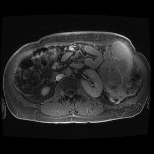 Acinar cell carcinoma of the pancreas (Radiopaedia 75442-86668 Axial late phase (~30 mins) 22).jpg