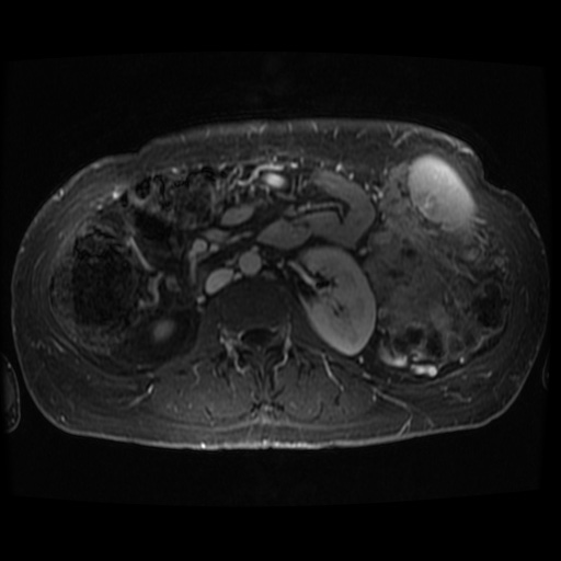 Acinar cell carcinoma of the pancreas (Radiopaedia 75442-86668 D 19).jpg