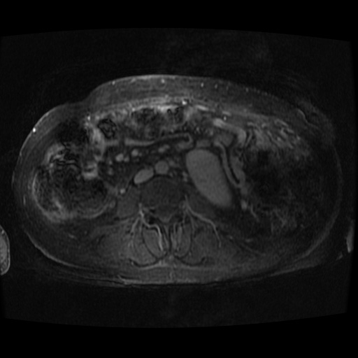 Acinar cell carcinoma of the pancreas (Radiopaedia 75442-86668 D 3).jpg